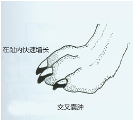 交叉囊肿